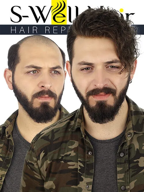protez saç foto