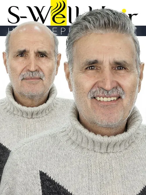 white hair replacement
