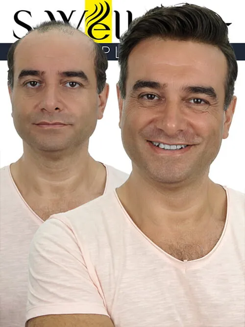 استبدال الشعر
