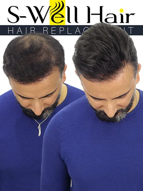 non surgical hair replacement