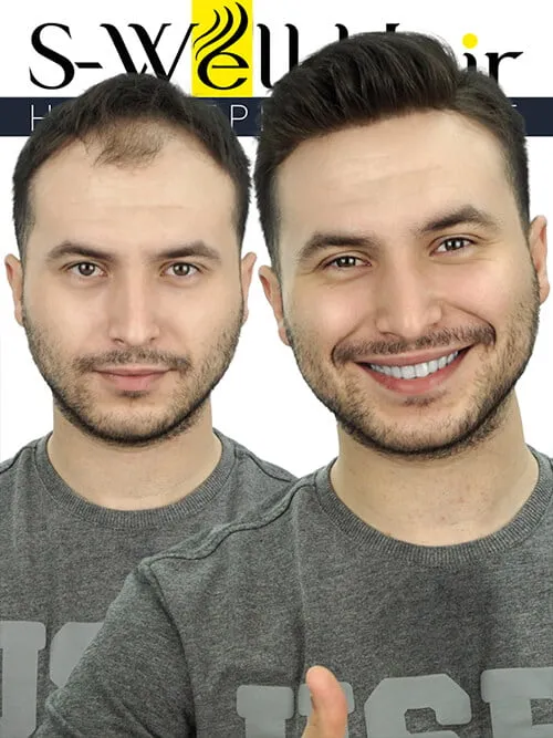 protez saç öncesi