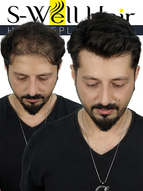 hair replacement before after