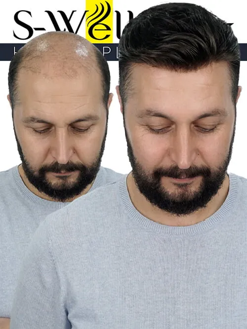 prosthetic hair