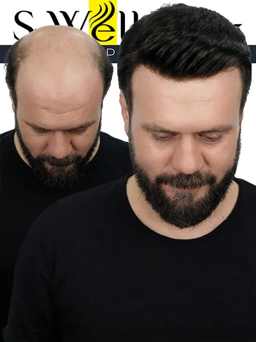 protez saç öncesi sonrası