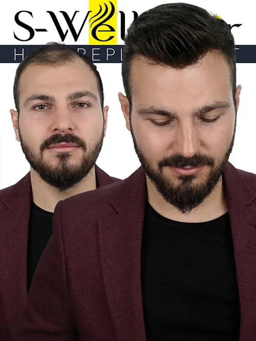 protez peruk