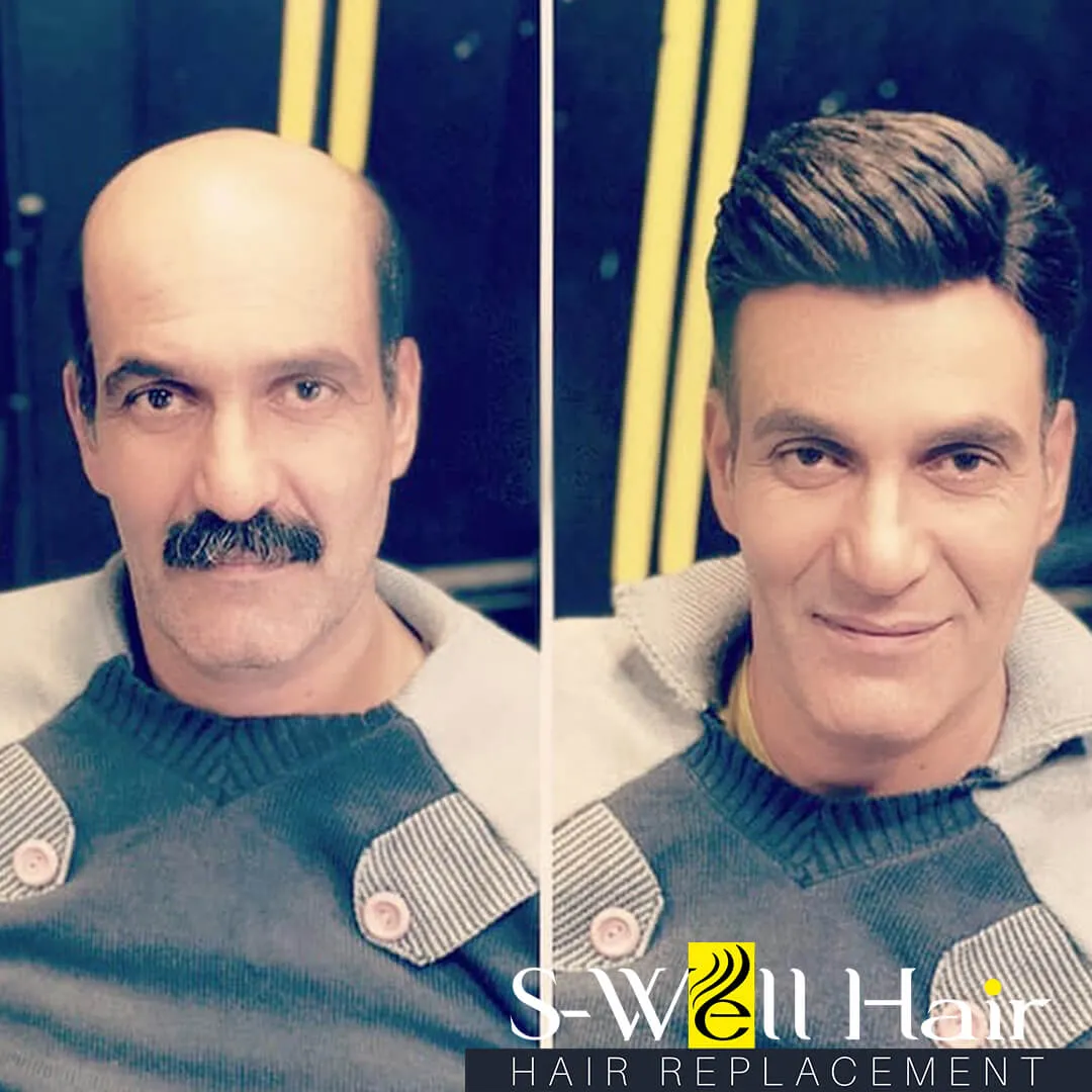protez saç fotoğrafları