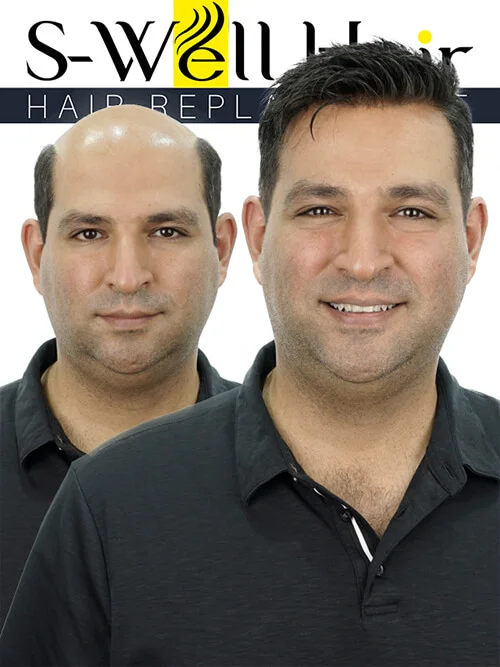 protesi capelli