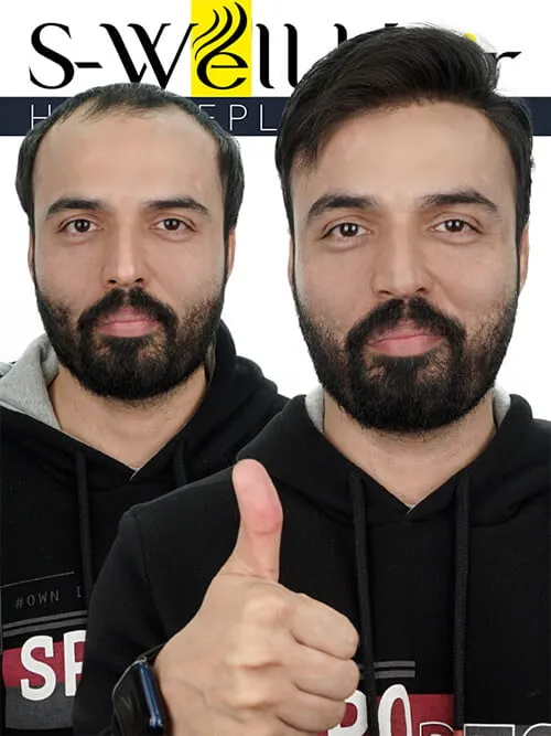 gerçek protez saç