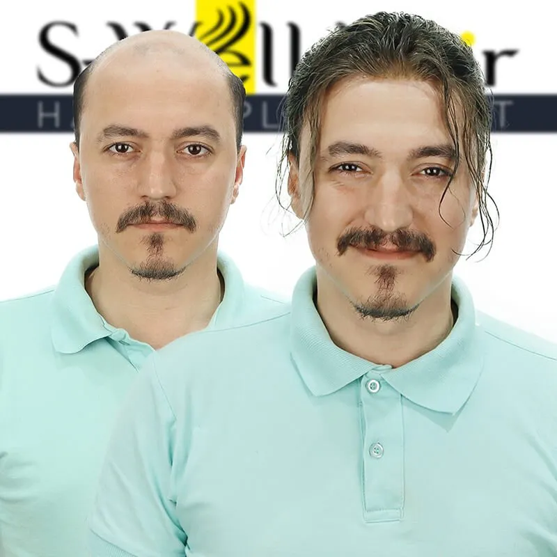kellik tedavisi