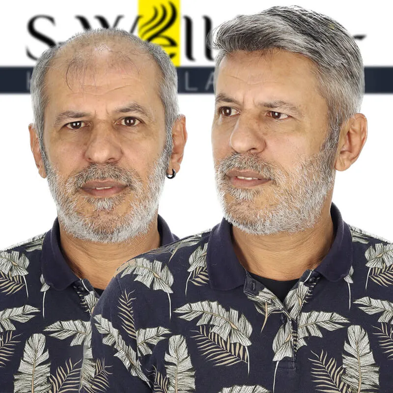 hair transplant