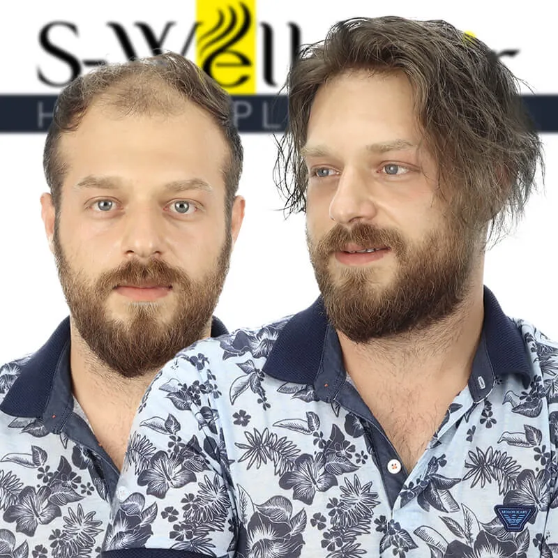 saç protezi