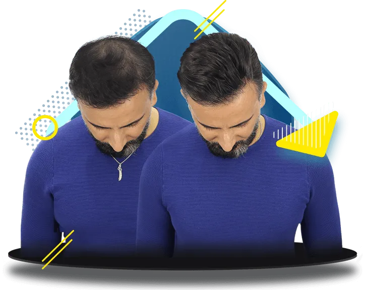 bantsız protez saç