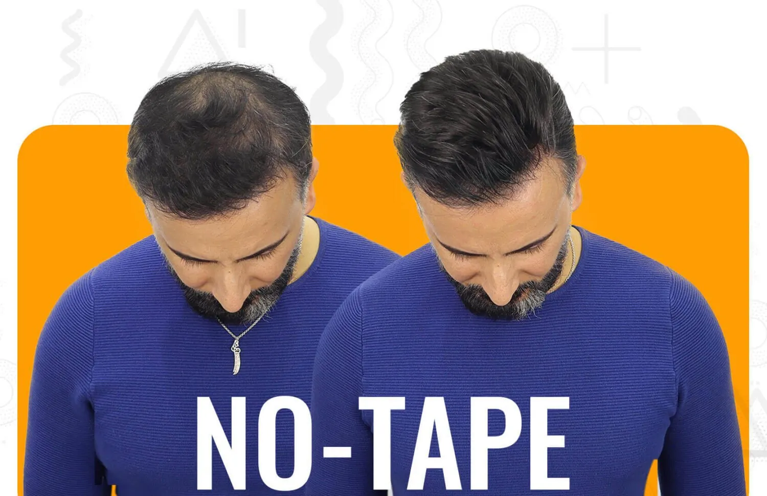 no-tape-hair-replacement (1)