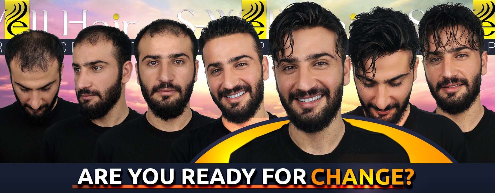 hair replacement in istanbul