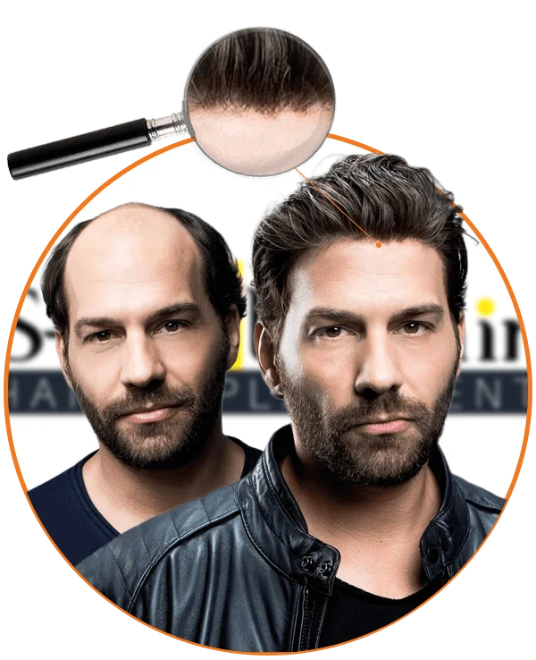 alın bölgesi doğal protez saç