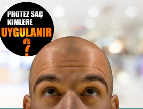 PROTEZ SAÇ KİMLERE UYGULANIR?